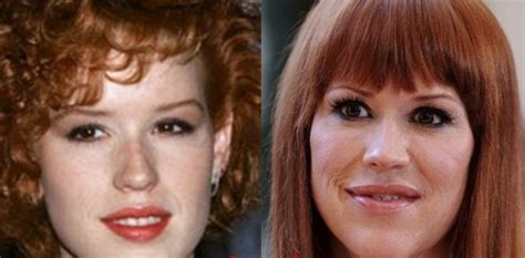 molly ringwald plastic surgery|Molly Ringwald Plastic Surgery: Before and After Transformation.